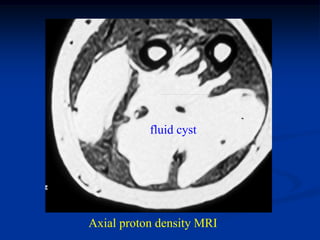 fluid cyst




Axial proton density MRI
 