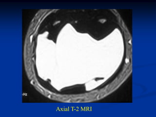 Axial T-2 MRI
 