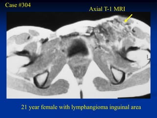 Case #304
                               Axial T-1 MRI




     21 year female with lymphangioma inguinal area
 