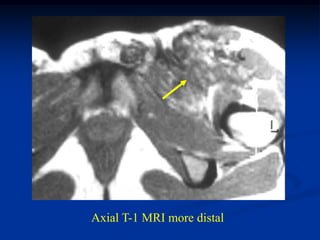 Axial T-1 MRI more distal
 