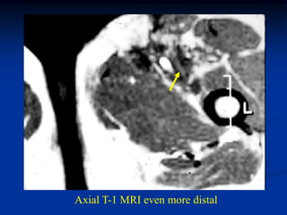Axial T-1 MRI even more distal
 