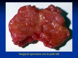 Surgical specimen cut in path lab
 
