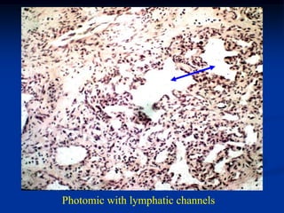 Photomic with lymphatic channels
 