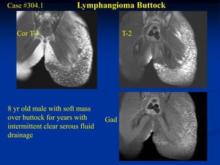Case #304.1             Lymphangioma Buttock


   Cor T-1                              T-2




8 yr old male with soft mass
over buttock for years with       Gad
intermittent clear serous fluid
drainage
 