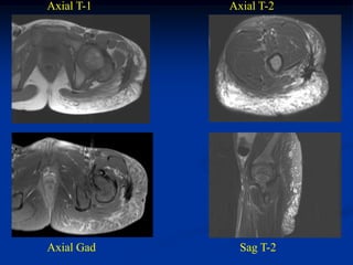 Axial T-1   Axial T-2




Axial Gad     Sag T-2
 