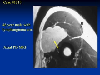 Case #1213




46 year male with
lymphangioma arm



Axial PD MRI
 