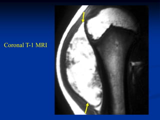 Coronal T-1 MRI
 