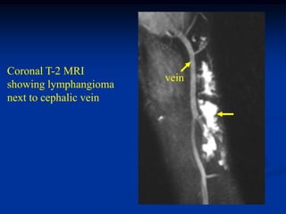 Coronal T-2 MRI
                        vein
showing lymphangioma
next to cephalic vein
 