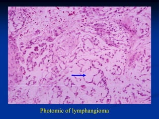 Photomic of lymphangioma
 