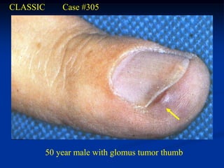 CLASSIC       Case #305




          50 year male with glomus tumor thumb
 
