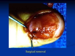 Surgical removal
 