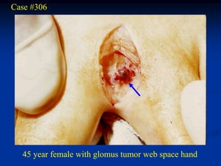 Case #306




  45 year female with glomus tumor web space hand
 