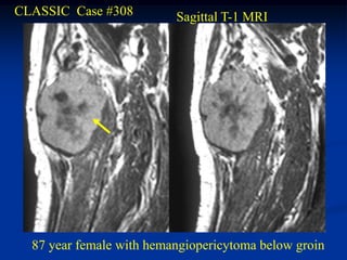 CLASSIC Case #308         Sagittal T-1 MRI




  87 year female with hemangiopericytoma below groin
 
