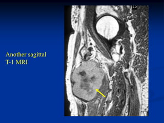 Another sagittal
T-1 MRI
 