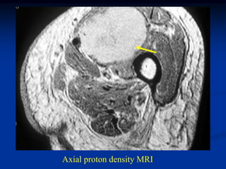 Axial proton density MRI
 