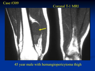 Case #309
                              Coronal T-1 MRI




      45 year male with hemangiopericytoma thigh
 