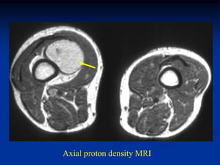 Axial proton density MRI
 