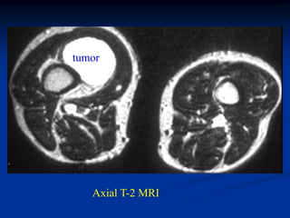 tumor




   Axial T-2 MRI
 