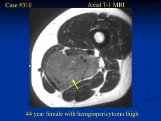 Case #310                     Axial T-1 MRI




       44 year female with hemgiopericytoma thigh
 