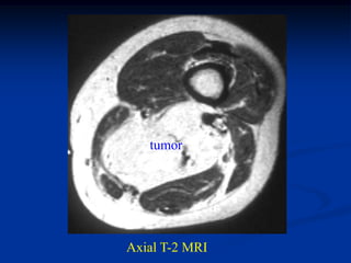 tumor




Axial T-2 MRI
 