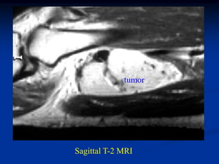 tumor




Sagittal T-2 MRI
 