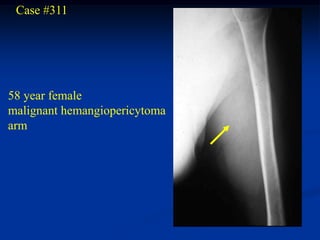 Case #311




58 year female
malignant hemangiopericytoma
arm
 