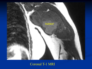 tumor




Coronal T-1 MRI
 