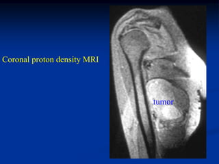 Coronal proton density MRI



                             tumor
 
