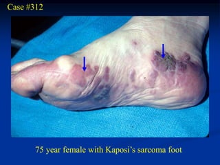 Case #312




       75 year female with Kaposi’s sarcoma foot
 