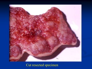 Cut resected specimen
 