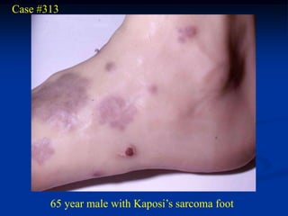 Case #313




       65 year male with Kaposi’s sarcoma foot
 