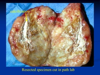 calcification




       Resected specimen cut in path lab
 