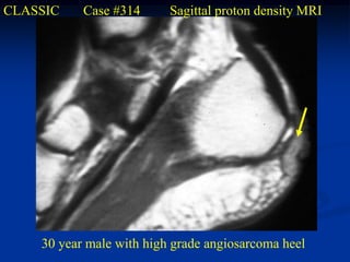 CLASSIC    Case #314      Sagittal proton density MRI




    30 year male with high grade angiosarcoma heel
 