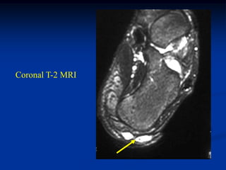 Coronal T-2 MRI
 