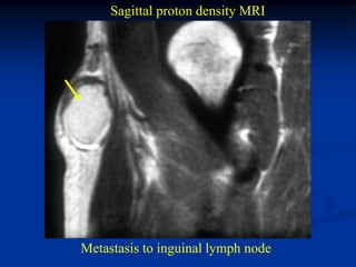 Sagittal proton density MRI




Metastasis to inguinal lymph node
 