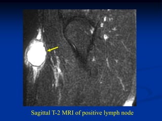 Sagittal T-2 MRI of positive lymph node
 