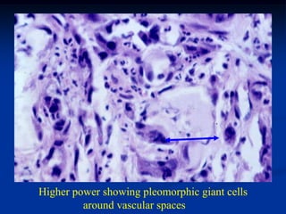 Higher power showing pleomorphic giant cells
         around vascular spaces
 