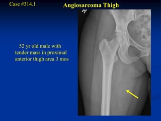 Case #314.1             Angiosarcoma Thigh




    52 yr old male with
  tender mass in proximal
  anterior thigh area 3 mos
 