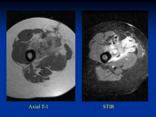 Axial T-1   STIR
 