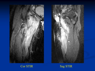 Cor STIR   Sag STIR
 