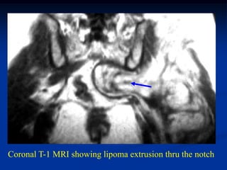 Coronal T-1 MRI showing lipoma extrusion thru the notch
 