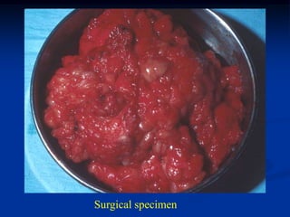 Surgical specimen
 
