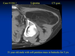 Case #1184.1              Lipoma               CT scan




   51 year old male with soft painless mass in buttocks for 5 yrs
 