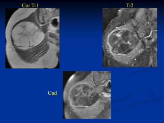 Cor T-1         T-2




          Gad
 