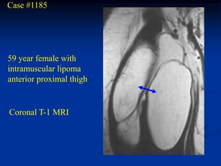 Case #1185




59 year female with
intramuscular lipoma
anterior proximal thigh


Coronal T-1 MRI
 