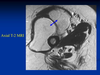 Axial T-2 MRI
 