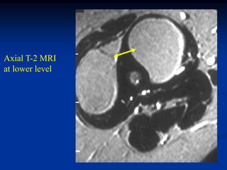 Axial T-2 MRI
at lower level
 