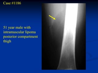 Case #1186




51 year male with
intramuscular lipoma
posterior compartment
thigh
 