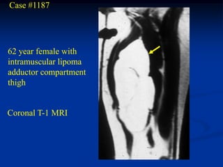 Case #1187




62 year female with
intramuscular lipoma
adductor compartment
thigh


Coronal T-1 MRI
 