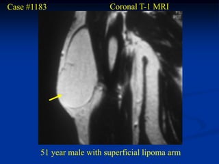 Case #1183                 Coronal T-1 MRI




        51 year male with superficial lipoma arm
 